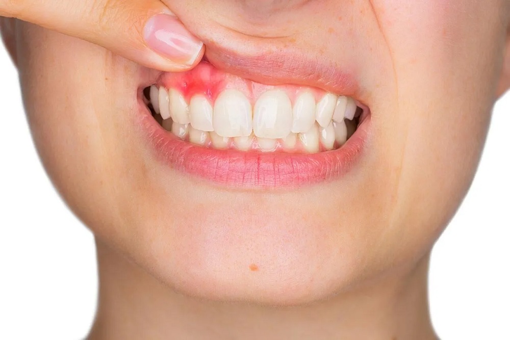 All You Need to Know About Gingivitis